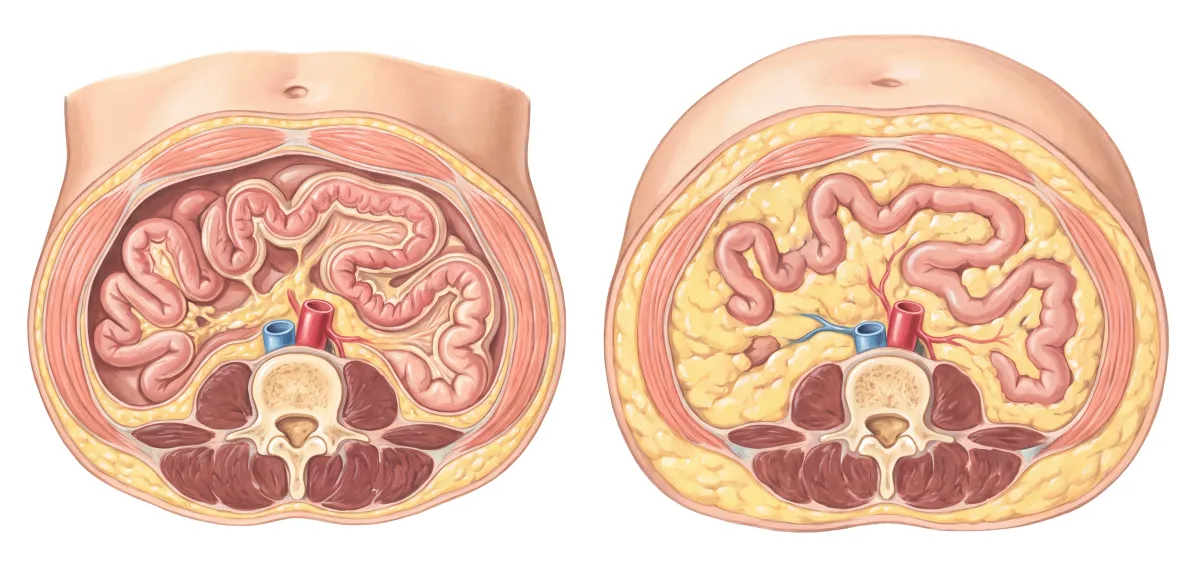 Planche : L'abdomen en coupe transversale. 1, Ventre sans surcharge (le repère) ; 2, Graisse autour des viscères (le poids se prend au ventre, malgré un apport modéré).
