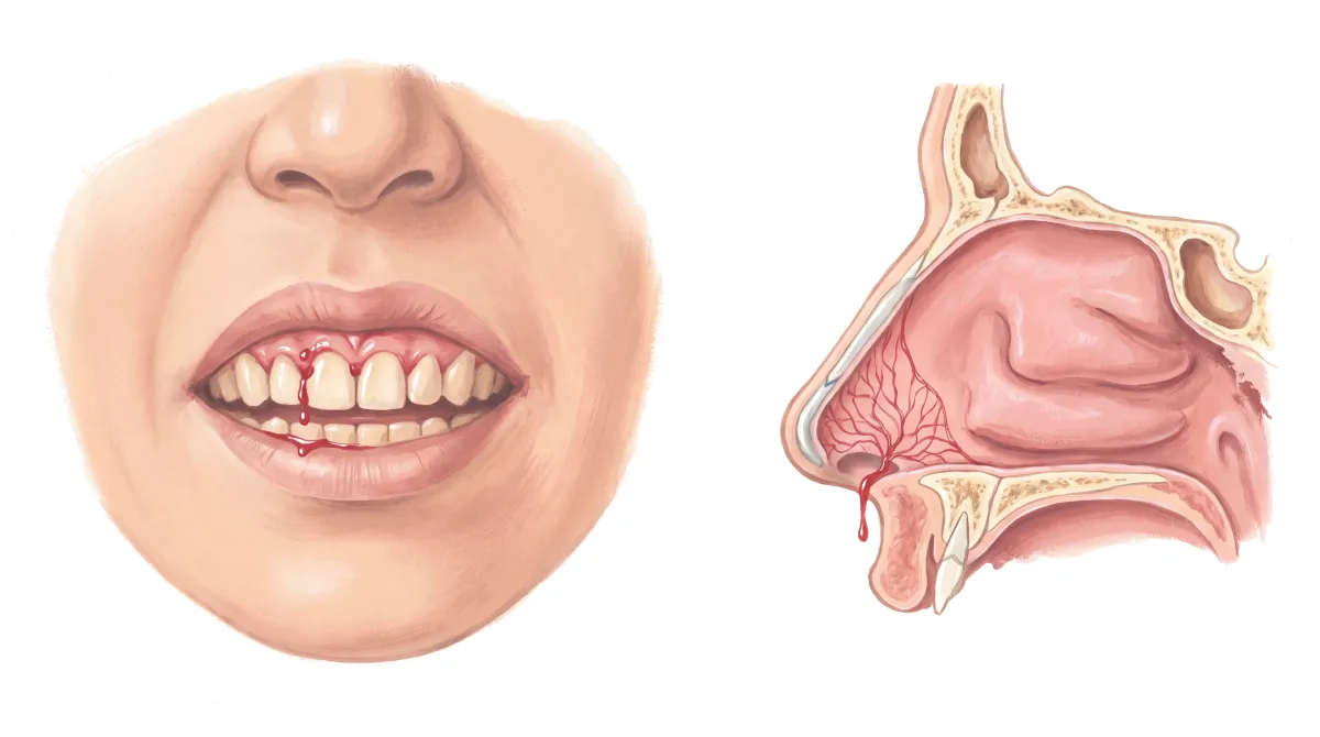 Planche : La bouche de face, et le nez en coupe. 1, Gencive (elle saigne seule ou au brossage) ; 2, Muqueuse de l'avant du nez (des épistaxis qui se répètent).