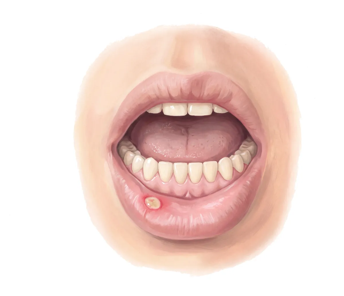 Planche : La bouche, vue de face. 1, Muqueuse de la lèvre (des aphtes qui reviennent quand le stress dure) ; 2, Langue (sèche, comme toute la muqueuse de la bouche).