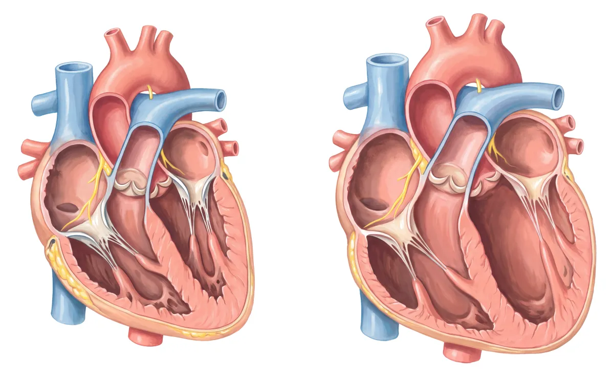 Planche : Le cœur en coupe, normal et dilaté. 1, Cœur normal (le repère) ; 2, Cœur dilaté (la cardiomyopathie de la maladie de Keshan, en carence profonde).
