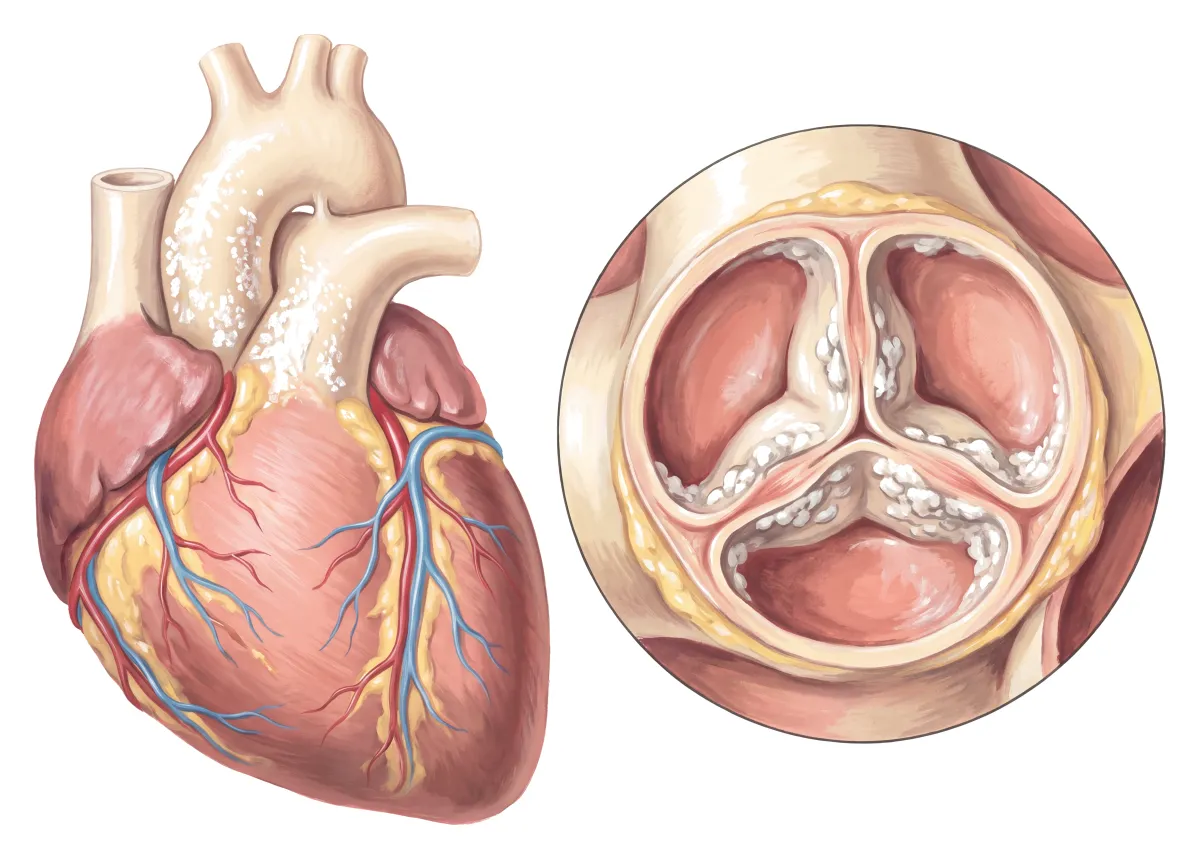 Planche : Le cœur vu de face, et la valve aortique vue d'en haut. 1, Aorte (des calcifications dans sa paroi) ; 2, Valve aortique (ses valvules se calcifient).