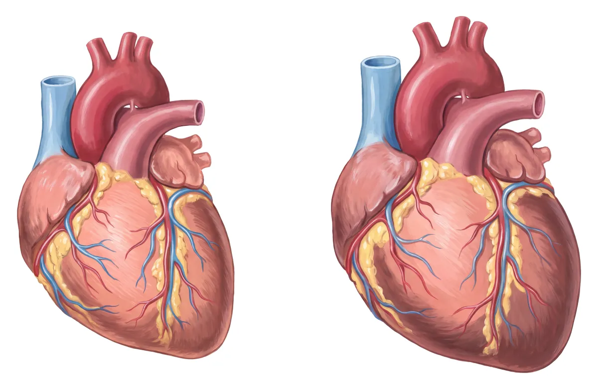 Planche : Le cœur vu de face, normal et agrandi. 1, Cœur normal (le repère) ; 2, Cœur agrandi (la cardiomégalie ; au stade humide, une insuffisance cardiaque à débit élevé).