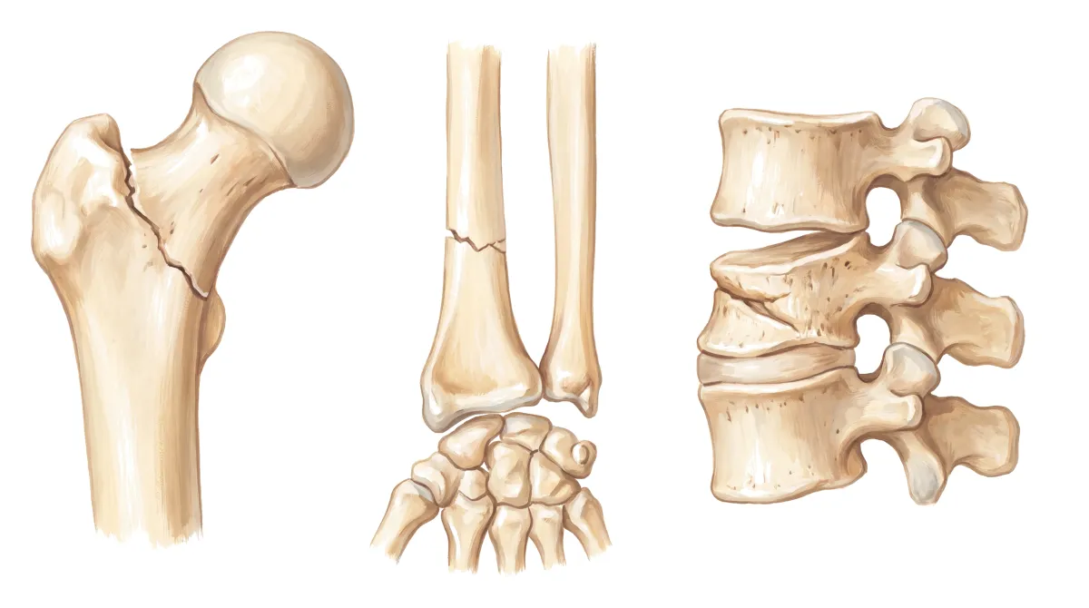 Planche : La hanche, le poignet et le rachis. 1, Haut du fémur (la fracture de la hanche) ; 2, Radius (la fracture du poignet) ; 3, Vertèbre (tassée, en coin).