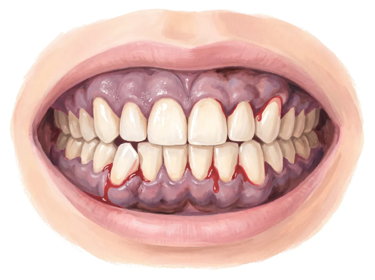 Planche : Les gencives et les dents, vues de face. 1, Gencives (gonflées, violacées, friables) ; 2, Dent (elle bouge : un signe tardif) ; 3, Bord de la gencive (il saigne à la pression légère : la gingivite).