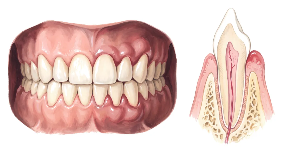 Planche : Les gencives de face, une dent en coupe. 1, Gencives (inflammées) ; 2, Parodonte (ce qui tient la dent, devenu sensible).
