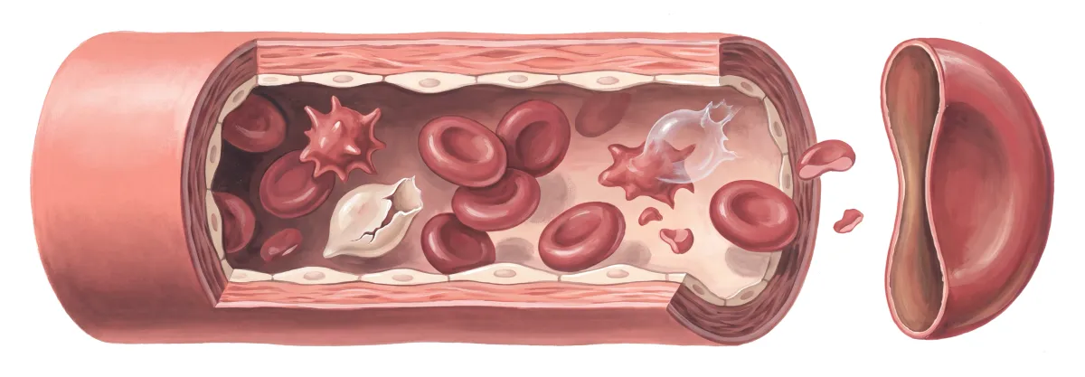 Planche : Un petit vaisseau ouvert, ses globules rouges. 1, Globules déformés (leur membrane est fragilisée) ; 2, Globules qui éclatent (une hémolyse discrète : palpitations à l'effort) ; 3, Membrane du globule (riche en acides gras fragiles, la vitamine E la protège de l'oxydation).
