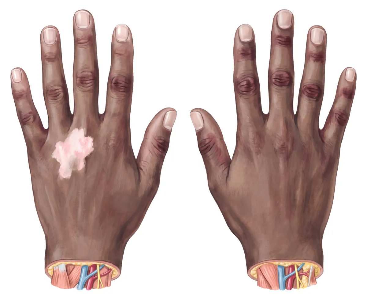 Planche : Le dos des mains. 1, Plis des doigts (la peau fonce : l'hyperpigmentation) ; 2, Plaque dépigmentée (le vitiligo, associé à l'anémie pernicieuse auto-immune).
