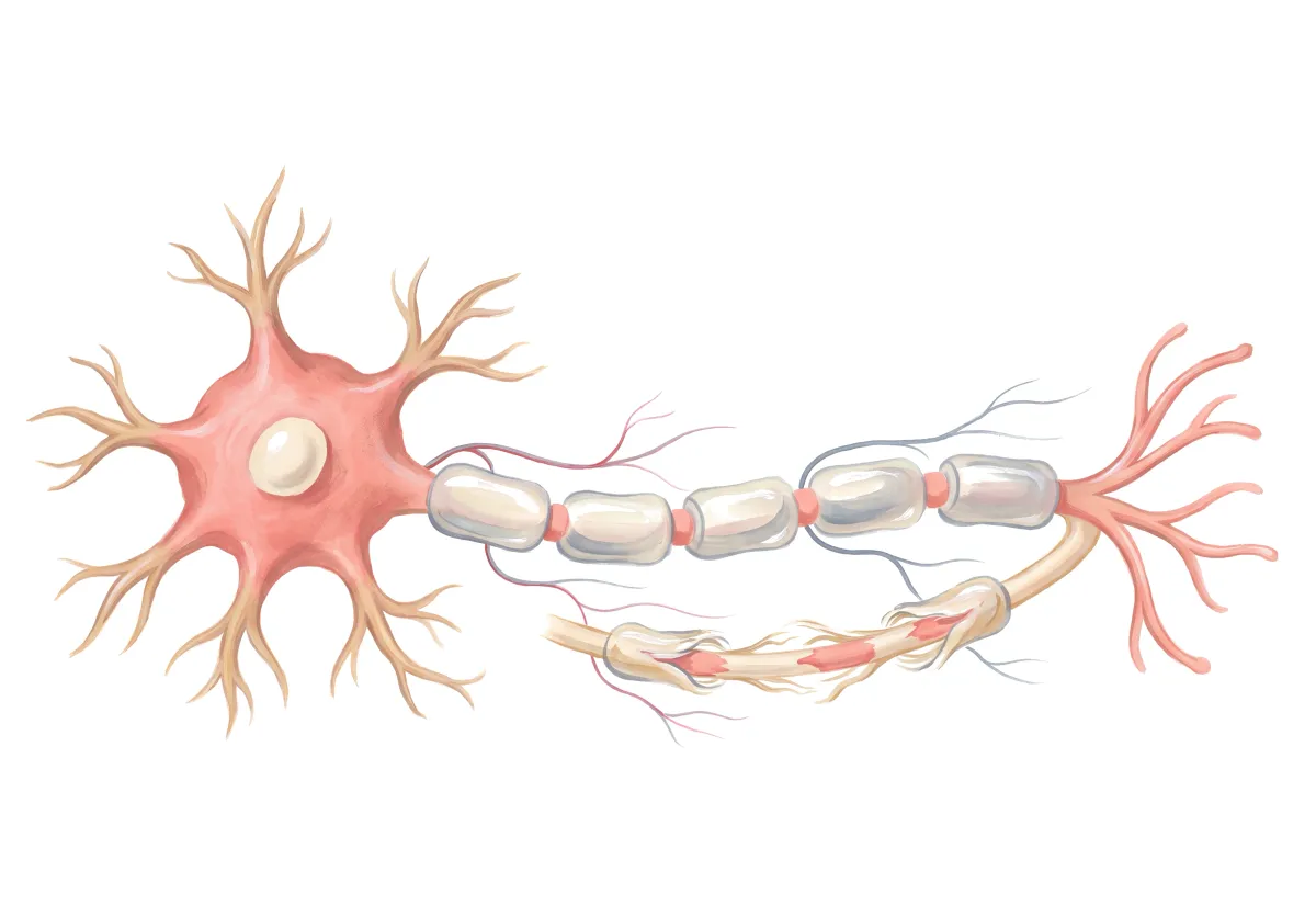 Planche : Le neurone et sa gaine de myéline. 1, Gaine de myéline (le repère) ; 2, Gaine abîmée (l'oxydation l'altère et perturbe la conduction) ; 3, Terminaisons nerveuses (neuropathie : fourmillements des extrémités).