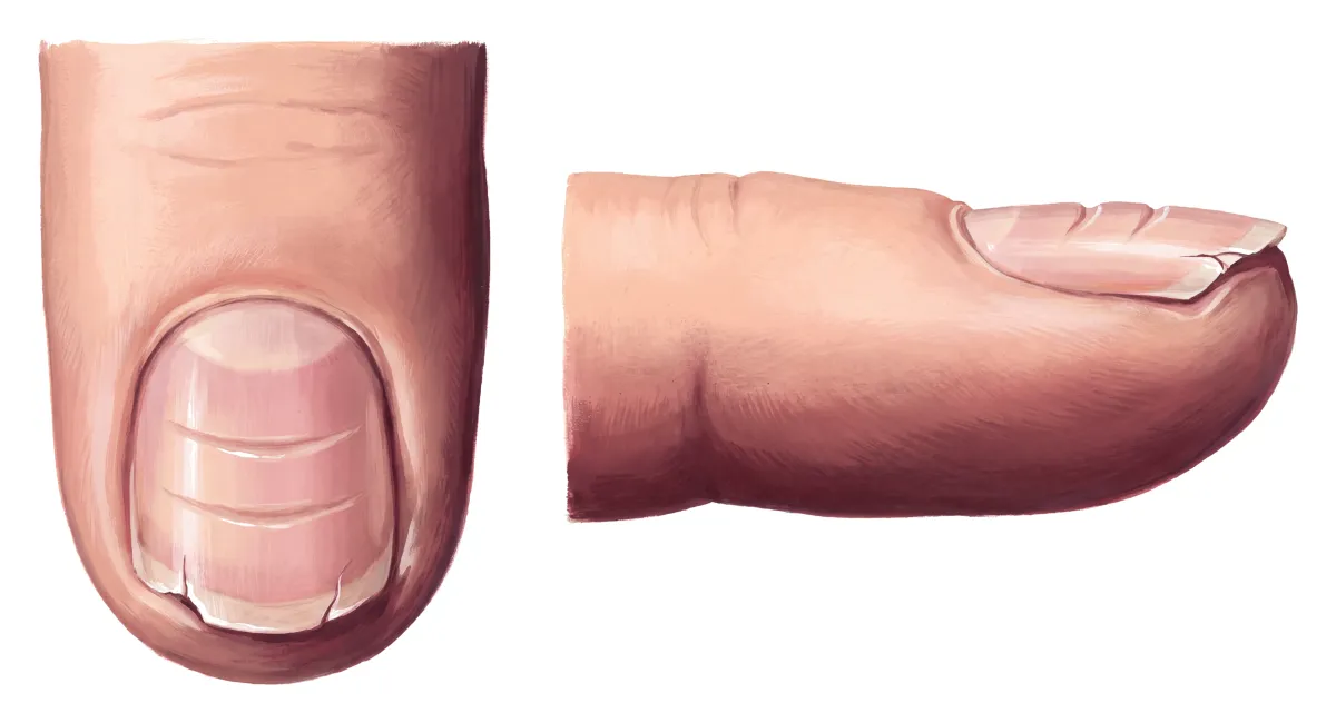 Planche : L'ongle, vu de dessus et de profil. 1, Stries en travers (des sillons, à ne pas confondre avec les taches blanches du zinc) ; 2, Bord libre (fragile, il se fend).