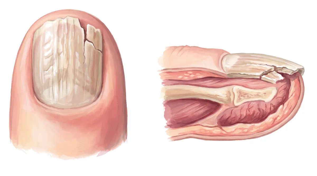 Planche : L'ongle, vu de dessus et en coupe. 1, Bord libre (il casse) ; 2, Tablette épaisse (l'ongle s'épaissit) ; 3, Stries longitudinales.