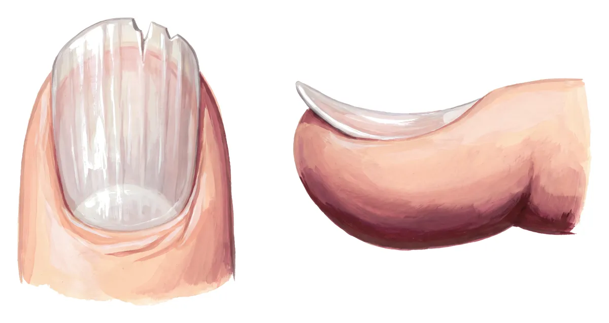 Planche : L'ongle, vu de dessus et de profil. 1, Bord libre (fragile, il se fend) ; 2, Ongle en cuillère (la koïlonychie : la tablette se creuse) ; 3, Stries longitudinales.