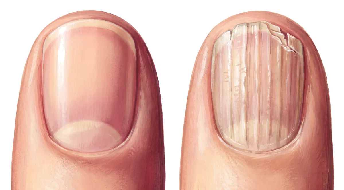 Planche : L'ongle vu de dessus, sain puis strié. 1, Ongle lisse (le repère) ; 2, Stries longitudinales (l'ongle se strie dans sa longueur) ; 3, Bord libre (fragile, il casse).