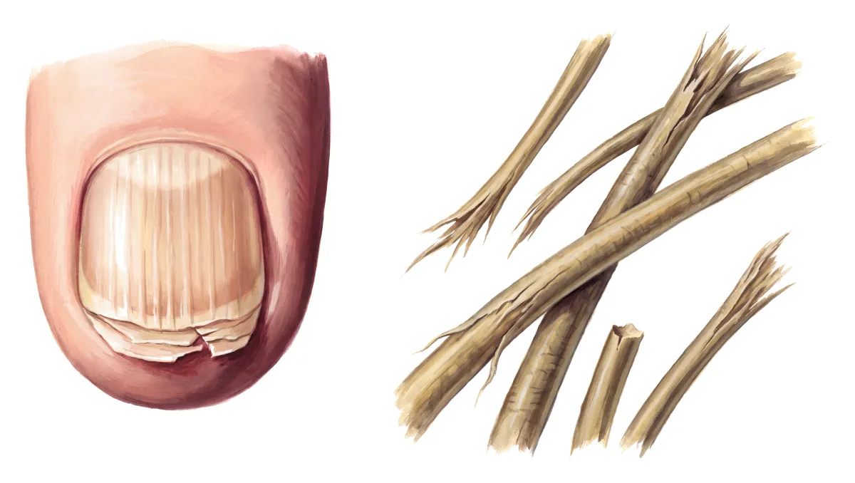Planche : L'ongle vu de dessus, et des cheveux agrandis. 1, Ongle strié ; 2, Ongle fragile ; 3, Cheveux secs, cassants (une chute diffuse modérée).