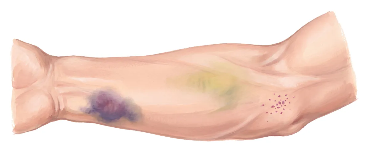 Planche : L'avant-bras, sa face interne. 1, Ecchymoses (des bleus qui viennent facilement : un signe tardif) ; 2, Pétéchies (rares, le signe d'un déficit sévère).