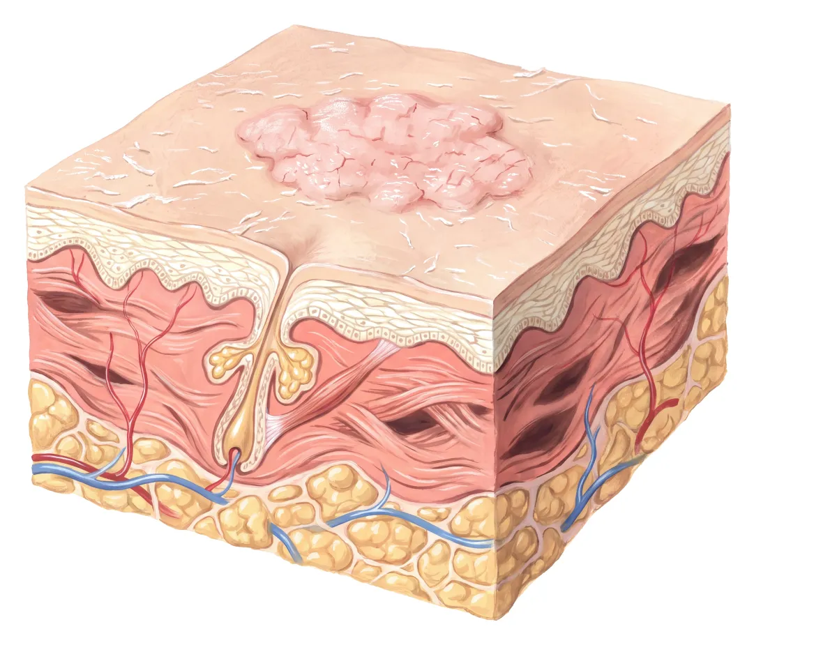 Planche : La peau en coupe. 1, Surface de la peau (sèche, qui pèle) ; 2, Plaque rugueuse (la tendance eczémateuse).