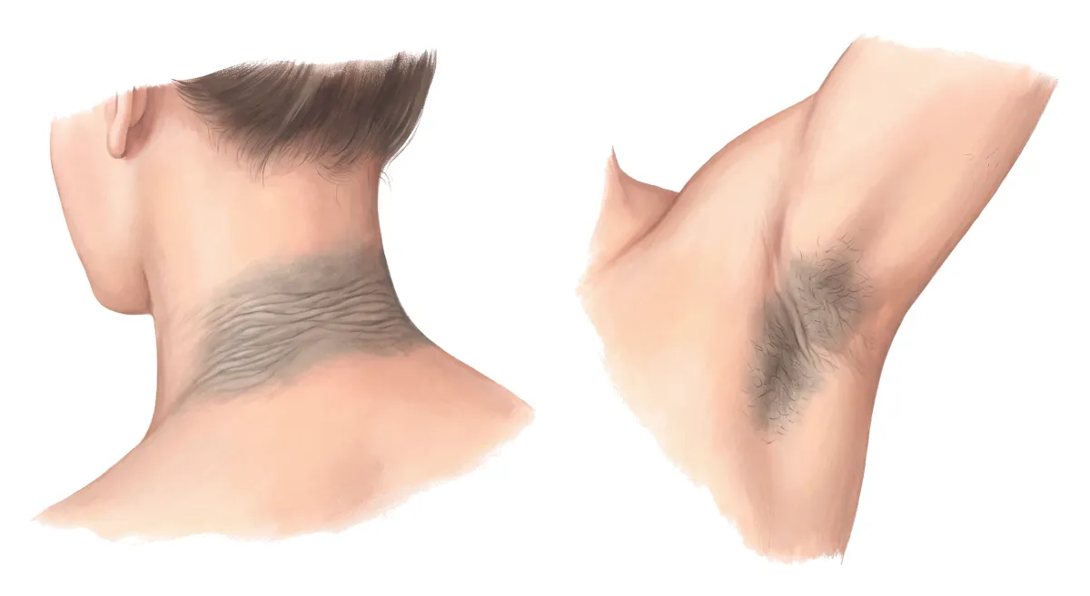 Planche : Le cou et l'aisselle. 1, Peau des plis (épaissie et brune : l'acanthosis nigricans).
