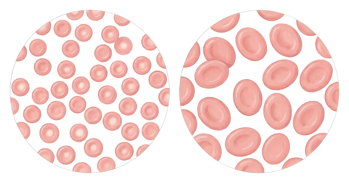 Planche : Le sang au microscope. 1, Globules rouges normaux (le repère) ; 2, Globules rouges agrandis (la macrocytose, parfois sans anémie franche).