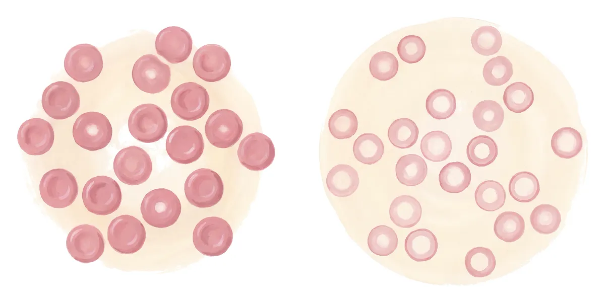 Planche : Le sang au microscope. 1, Globules rouges normaux (le repère) ; 2, Globules rouges petits et pâles (une anémie microcytaire, qui résiste au fer seul).
