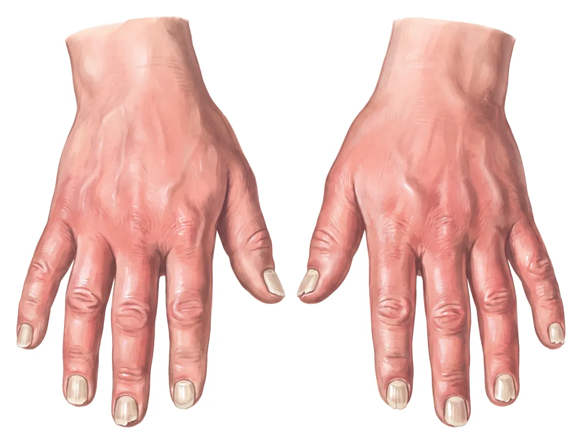 Planche : Les mains, dans l'excès. 1, Ongles (épais, cassants) ; 2, Peau des mains (rouge et gonflée).