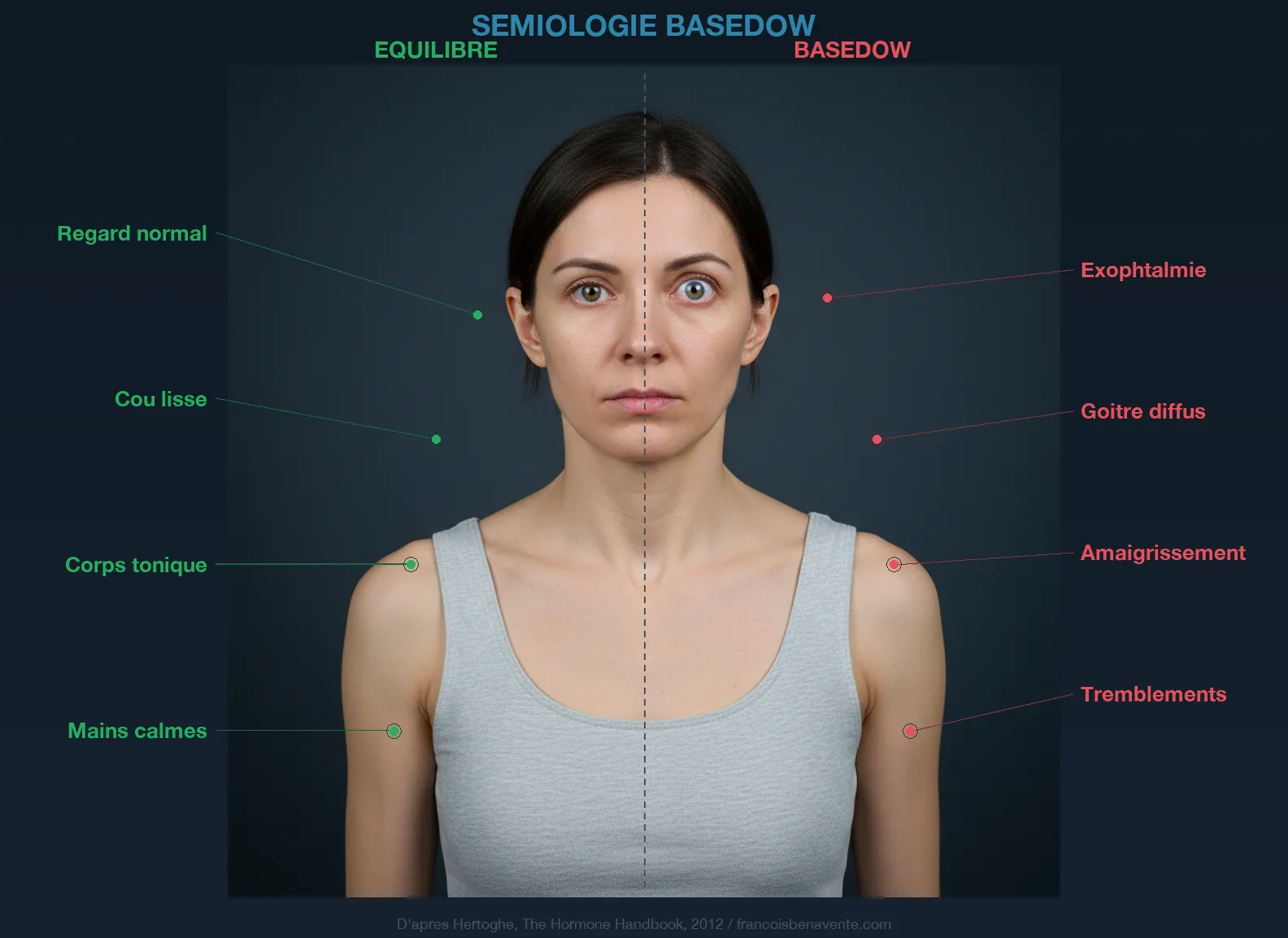 Sémiologie Basedow : signes cliniques visibles de l'hyperthyroïdie auto-immune