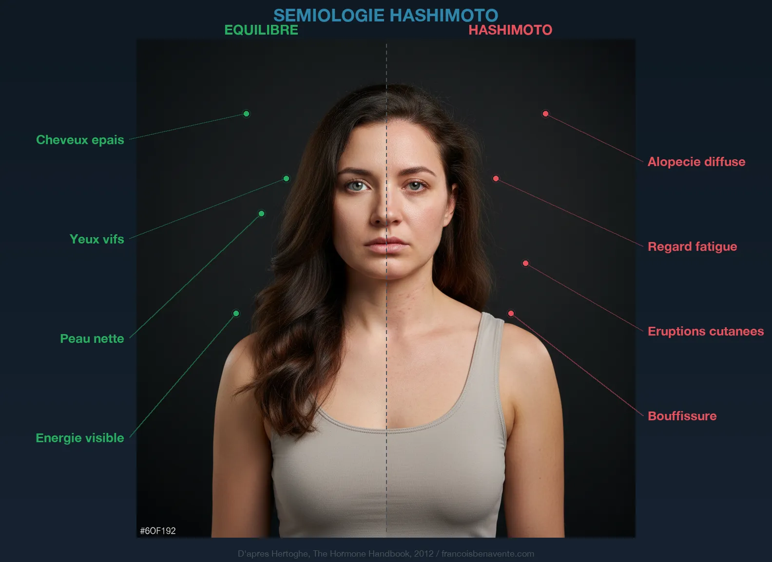 Sémiologie Hashimoto : signes cliniques visibles de la thyroïdite auto-immune
