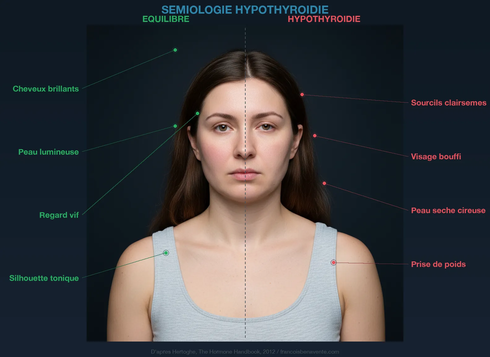 Sémiologie de l'hypothyroïdie : signes cliniques visibles comparés entre équilibre et hypothyroïdie