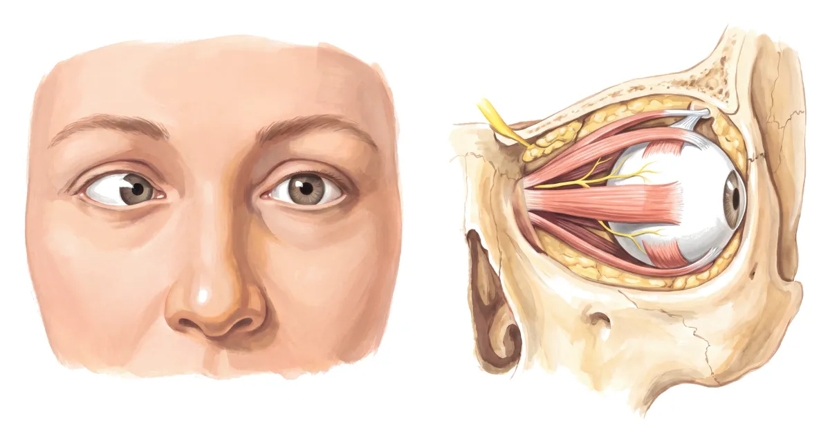 Planche : Les yeux de face, et l'œil dans son orbite. 1, Les 2 yeux (ils ne bougent plus ensemble) ; 2, Muscles de l'œil (ils répondent mal : l'ophtalmoplégie).