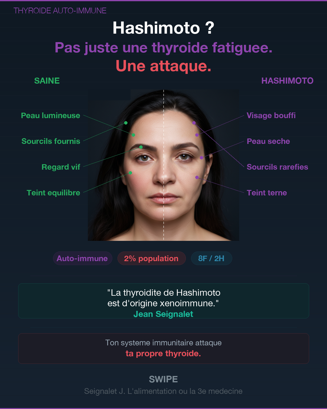 Hashimoto : ce que ta thyroïde essaie de te dire